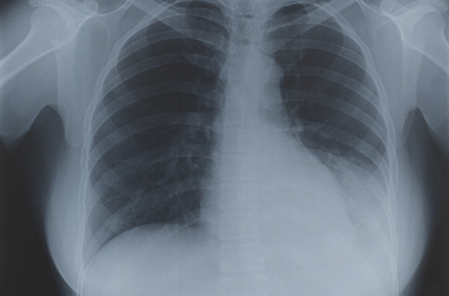 Chest X Ray To Check Fitness Is Outdated Health Gulf News