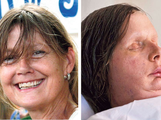Face transplant patients go public | Americas – Gulf News