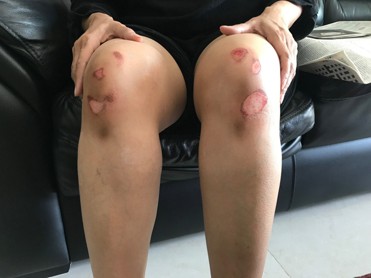 Woman suffers friction burns during gym class