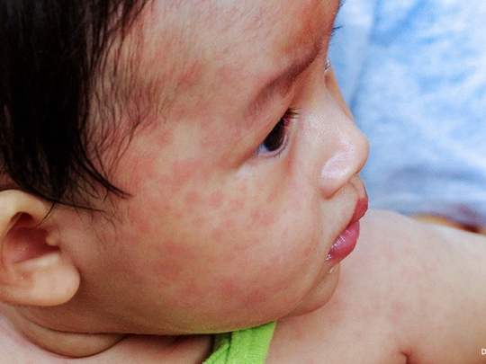 424 measles cases were recorded in Bicol