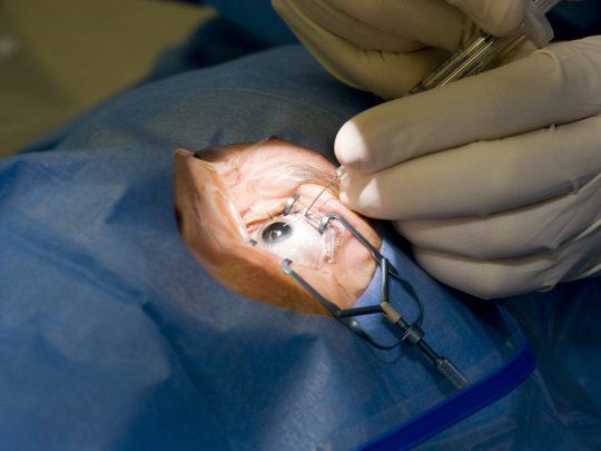 cataract-surgery-1553862525459