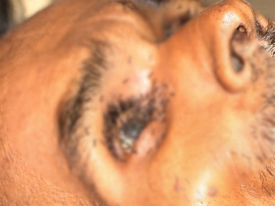 Ants crawling inside an eye of Balchandra Lodhi 