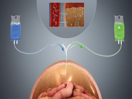 Wearable artificial kidney may improve peritoneal dialysis