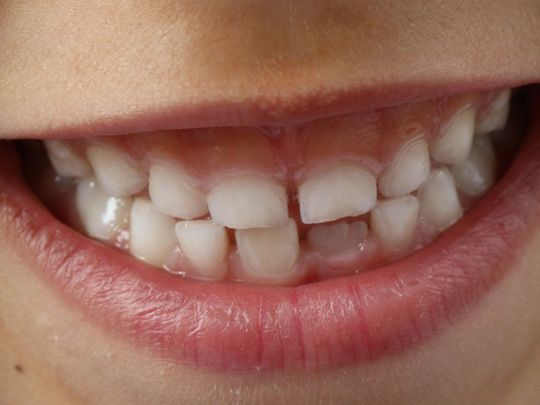 teeth generic
