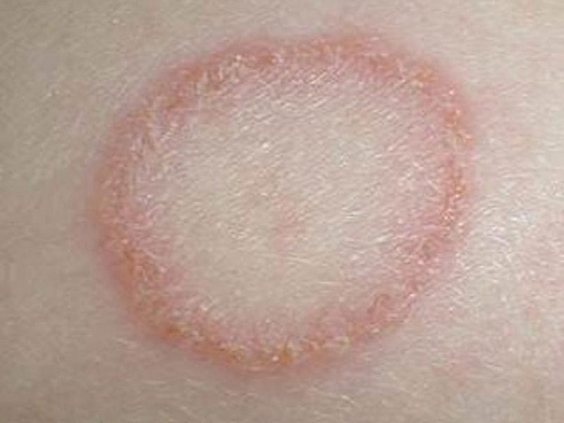 BC Ringworm (also known as tinea)