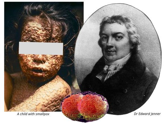 A child with smallpox (left) and a file photo of British scientist Dr Edward Jenner (right), who invented the smallpox vaccine in 1796. Inset, a computer-generated illustration of the virus that causes smallpox.