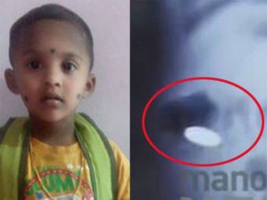 An X-ray showed the coin that the child had swallowed.