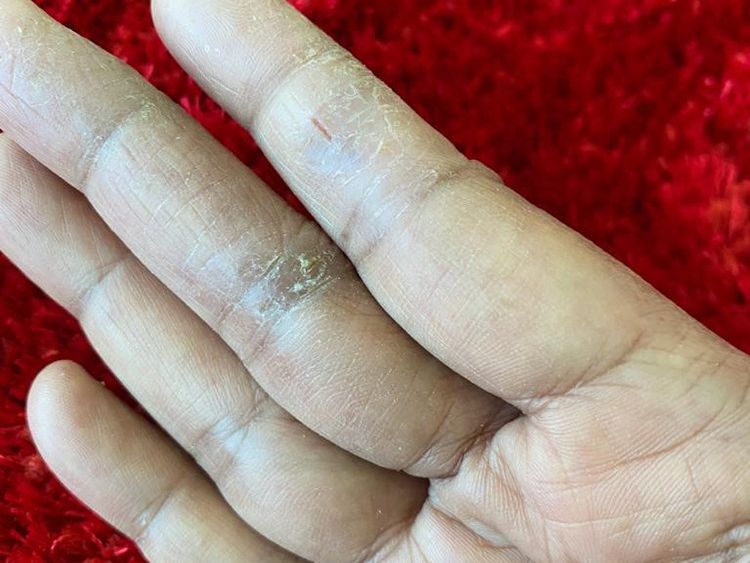 COVID-19: Why are hands of UAE residents feeling raw, dehydrated and itchy?  | Health – Gulf News