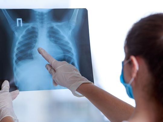 Researchers develop AI to detect COVID on chest x-rays