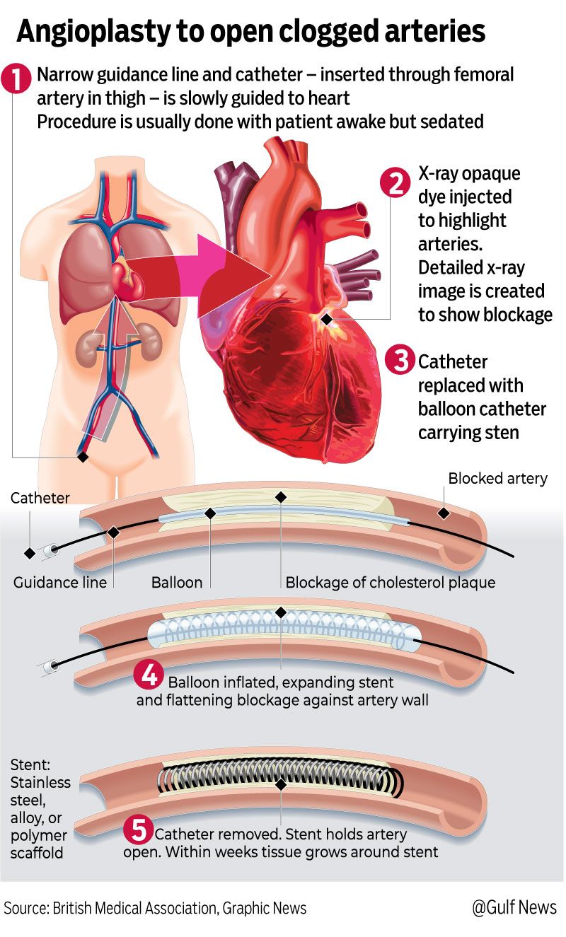Graphic angioplasty heart attack