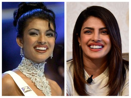 Priyanka Chopra Gets Candid About Botched Nose Surgery That Left Her