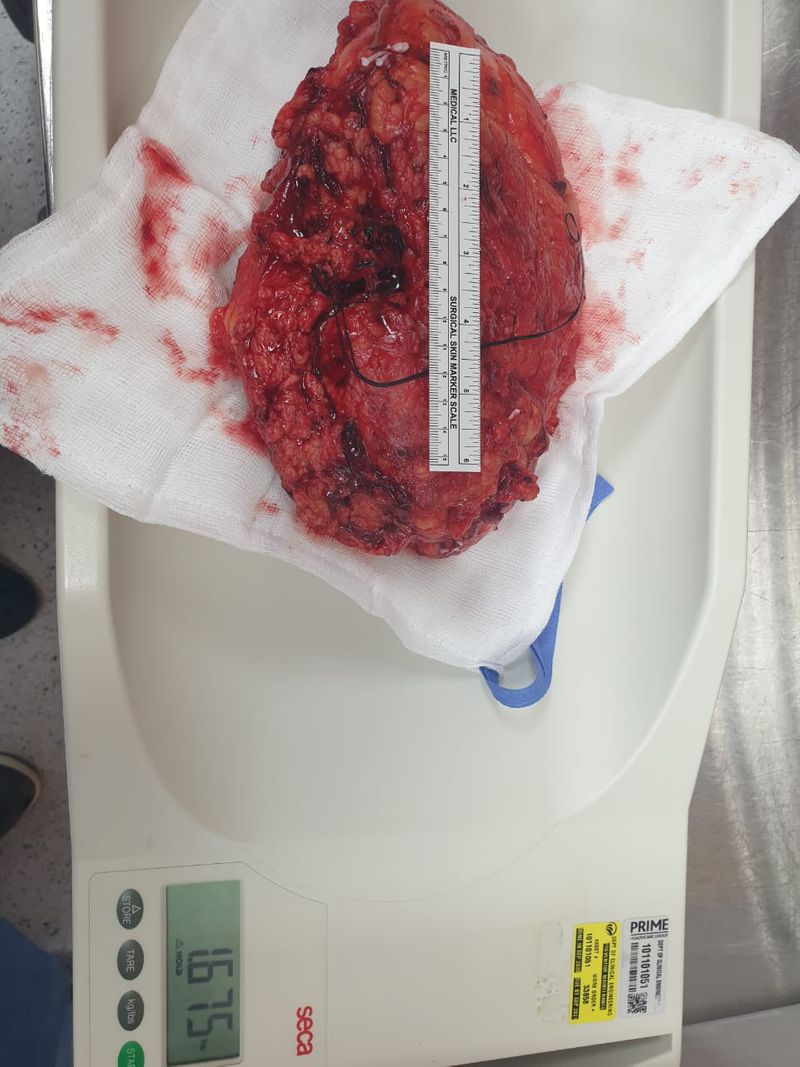 left kidney with 1.8 kg tumour-1624599153281