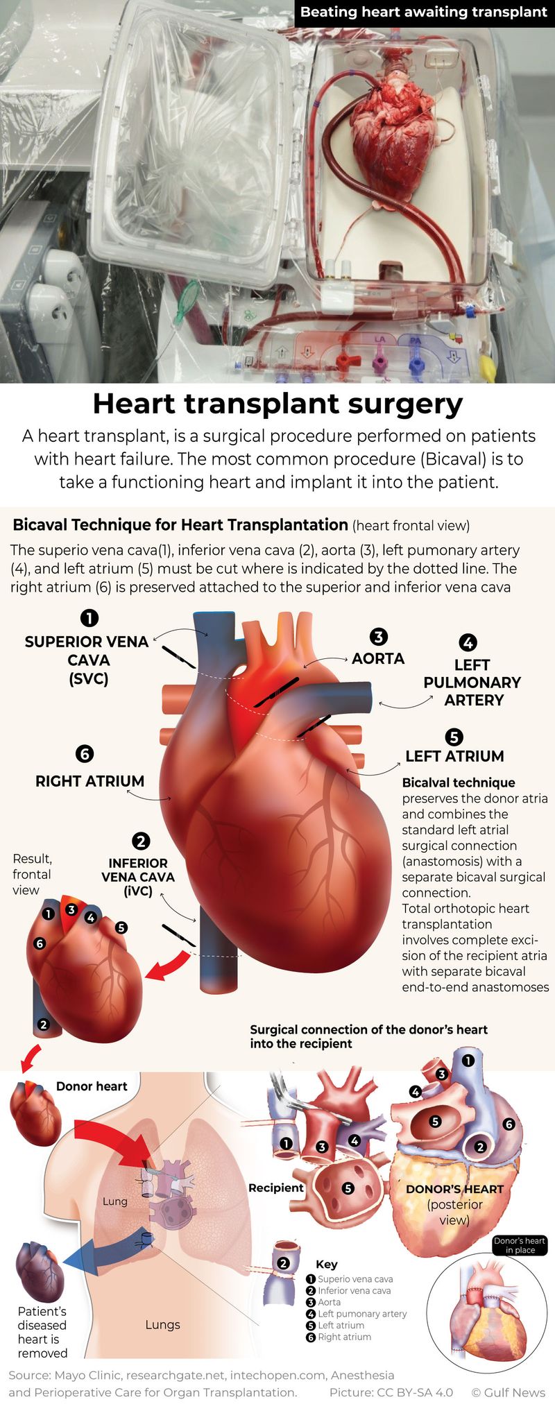 Heart transplant infographic