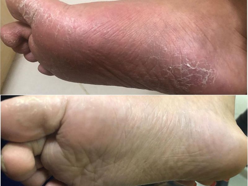 CHILD'S FOOT BEFORE AND AFTER