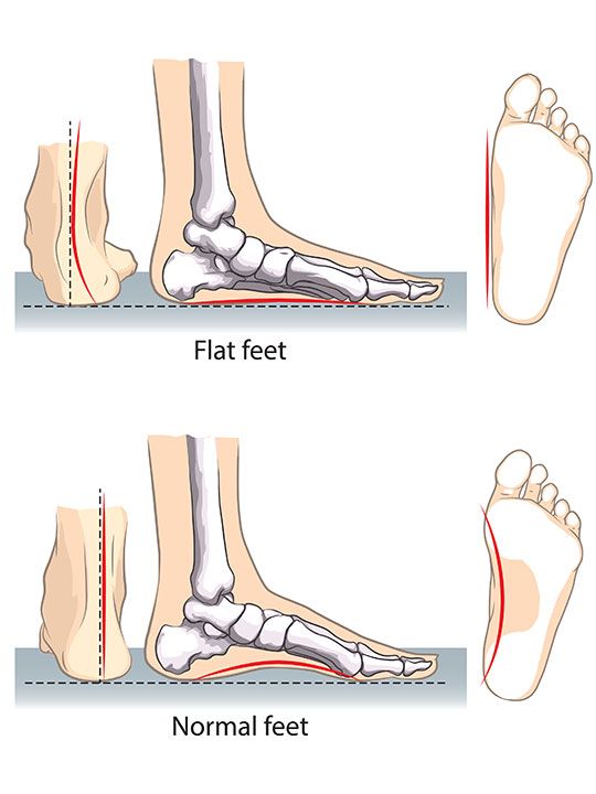 Normal vs flat foot