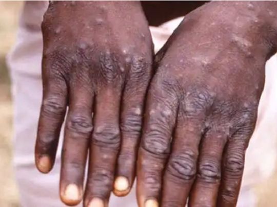 Monkeypox hands