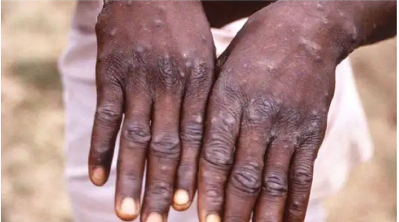 Monkey Pox Hands