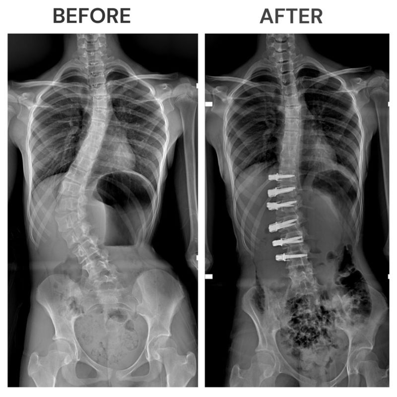 X-ray image of the spine before and after the surgery-1657085230990