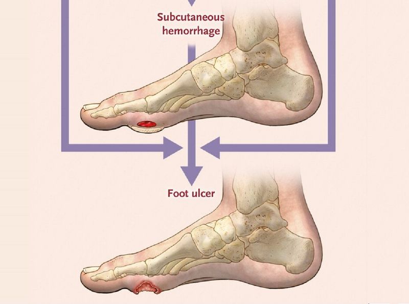 Diabetes foot ulcer NEJM