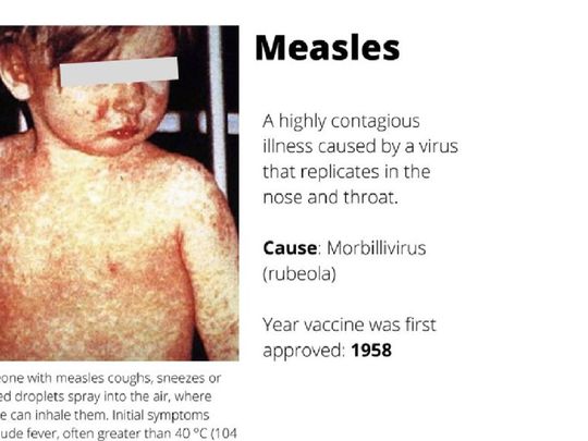 measles-1671851471129