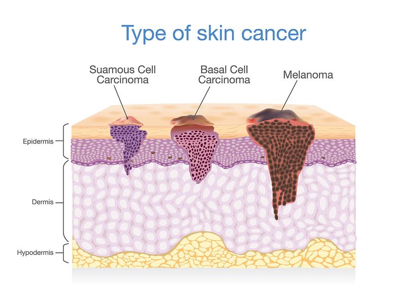 shutterstock_676089217 Skin layer have 3 Type of Cancer in one squamous cell carcinoma / basal cell carcinoma / melanoma