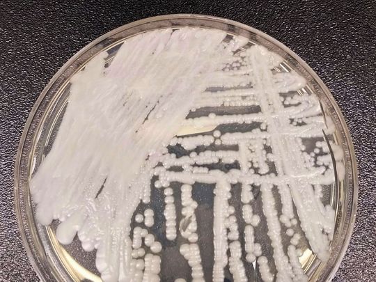 Deadly 'Candida auris' fungal infection is spreading in US hospitals. Here's what to know.