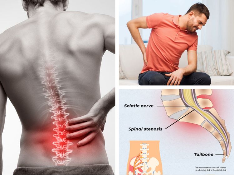 Sciatica: How to cure this excruciating back pain?