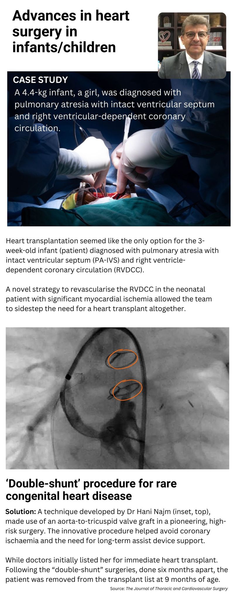 Najm technique double shunt heart surgery