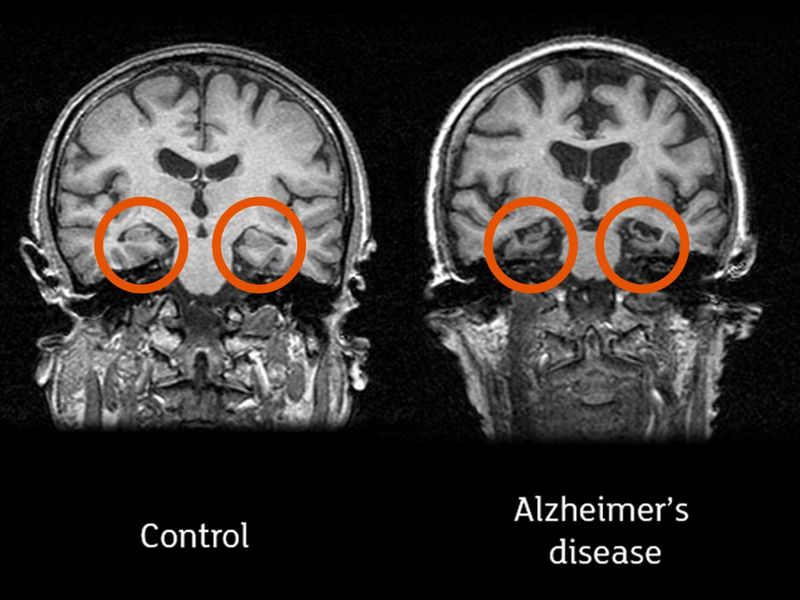 Brain Scan Alzheimer's Disease